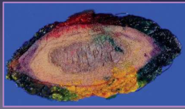 <ul><li><p>Do this! do this! do this! </p></li><li><p>allows for margin assessment </p><ul><li><p>3D margins: lateral and deep </p></li></ul></li><li><p>dictates adjunctive treatment plan </p></li></ul><p></p>