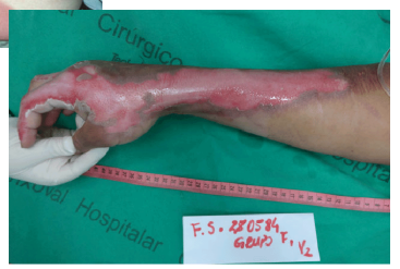 <p>Superficial partial thickness</p><p><em>Epidermis into the papillary layer of the dermis</em></p>