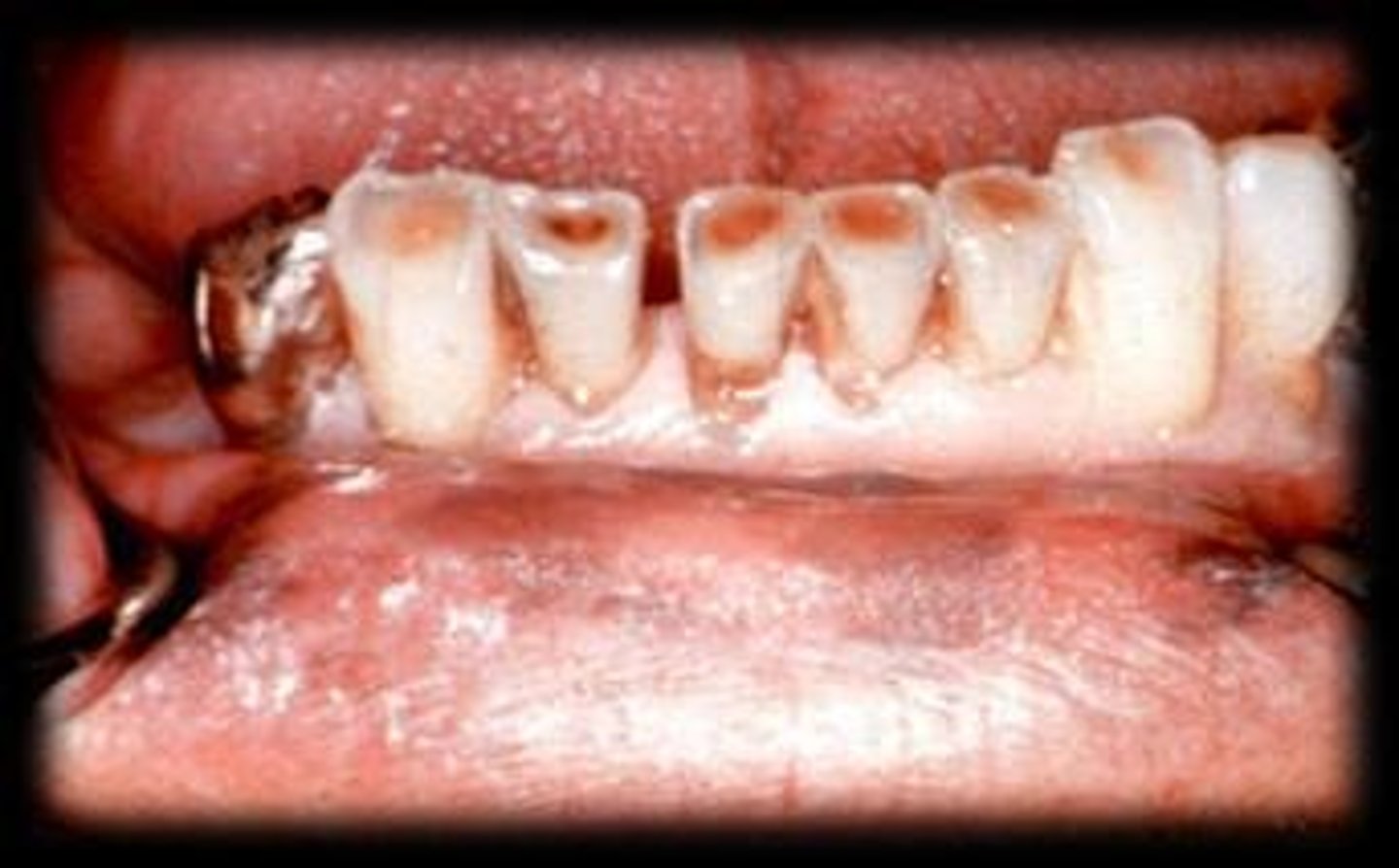 <p>Loss of tooth structure through tooth-to-tooth contact, resulting in shiny facets and matching wear on occluding surfaces.</p>