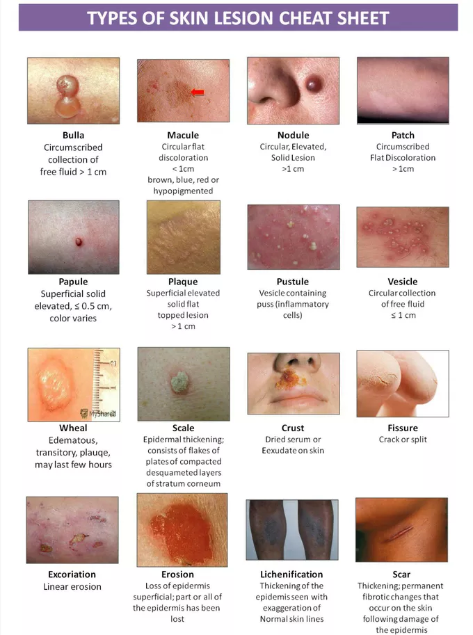 <p>small, pus filled bumps usually &lt;1 cm</p><ul><li><p>show an elevation of the epidermis </p></li><li><p>leak bacteria but in thicker areas of the skin</p></li><li><p>e.g. acne, impetigo </p></li></ul><p></p>