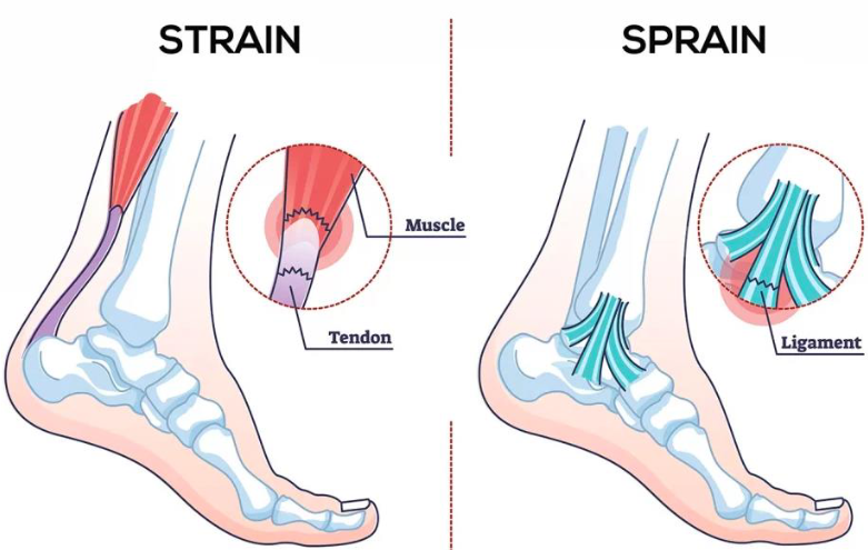<ul><li><p>Common joint injury</p></li><li><p>Reinforcing ligaments are stretched or torn</p></li><li><p>Partial tears are repair slow due to poor vascularization</p></li></ul><p></p>