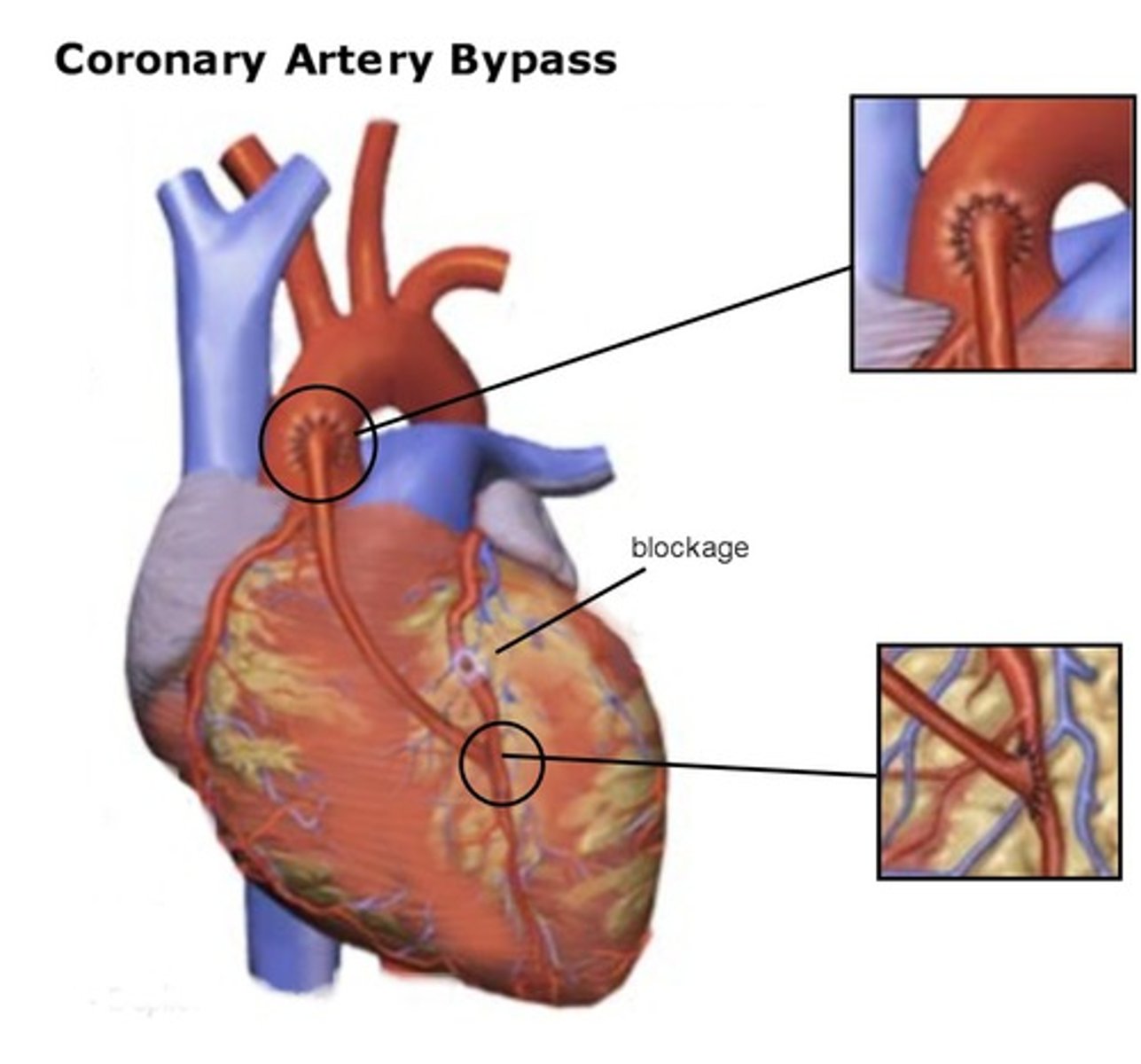<p>Placement of a vessel graft from another part of the body to bypass the blocked area of a coronary artery and restore blood supply to the heart muscle</p>