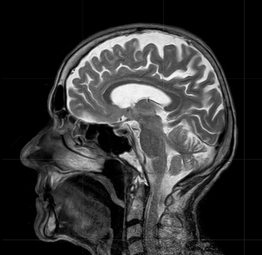 MRIs do not use radiation and can provide detail of very fine soft tissue. In an MRI machine, the patient lies down in a cylinder that has a very large magnet. MRI machines create images of the body using a large magnet and radio waves.