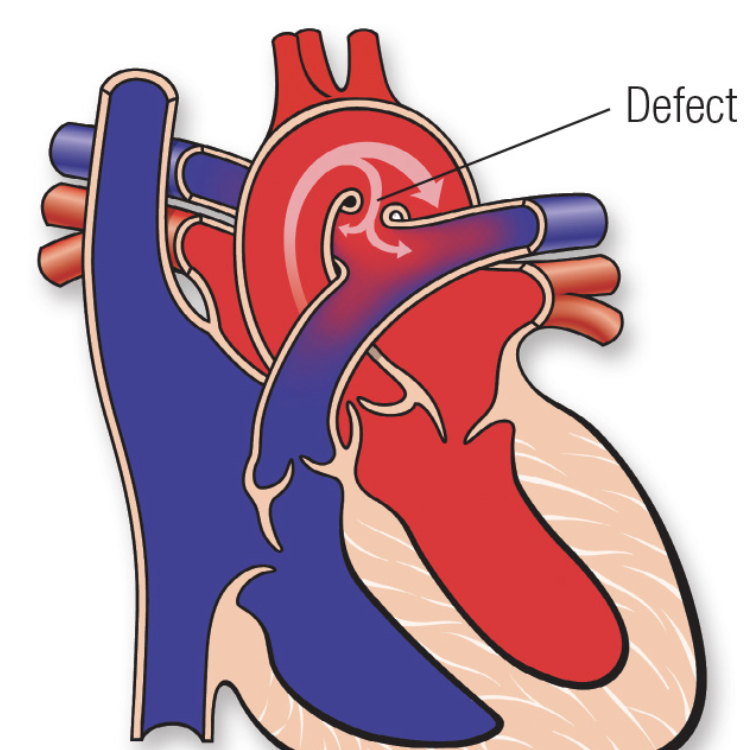 <p>pulsus arteriosus fails to close after birth, so blood from aorta flows into the pulmonary artery</p>