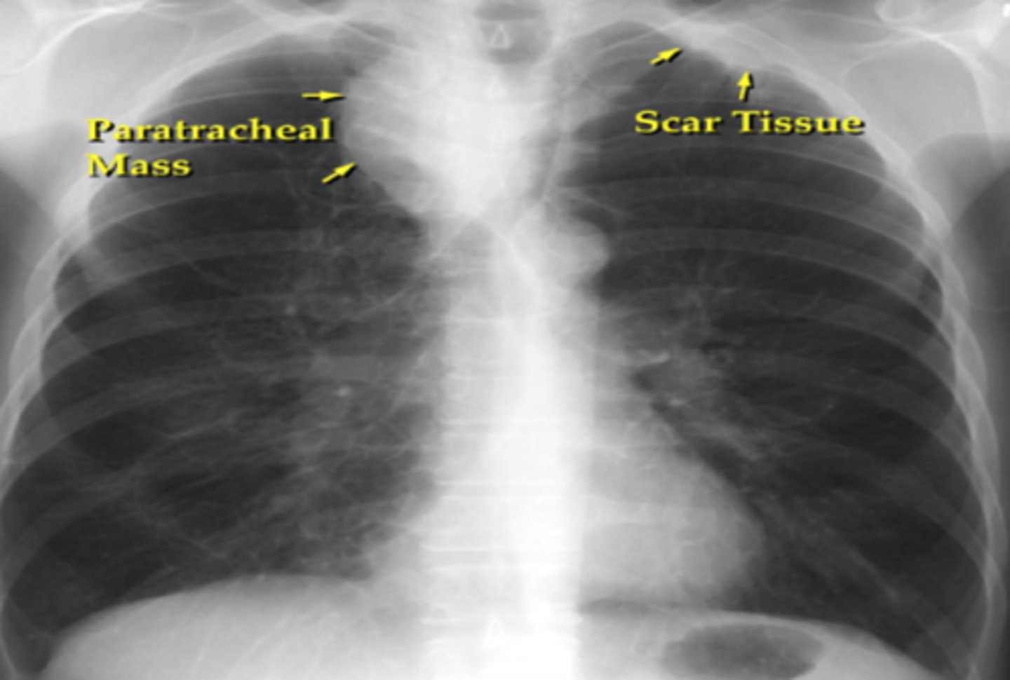 <p>-<b>C</b>entral<br>-<b>C</b>avitary<br>-hyper<b>C</b>alcemia<br>-<b>P</b>ancoast syndrome (evolves from SCC usually, mass seen in apex of lungs)</p>