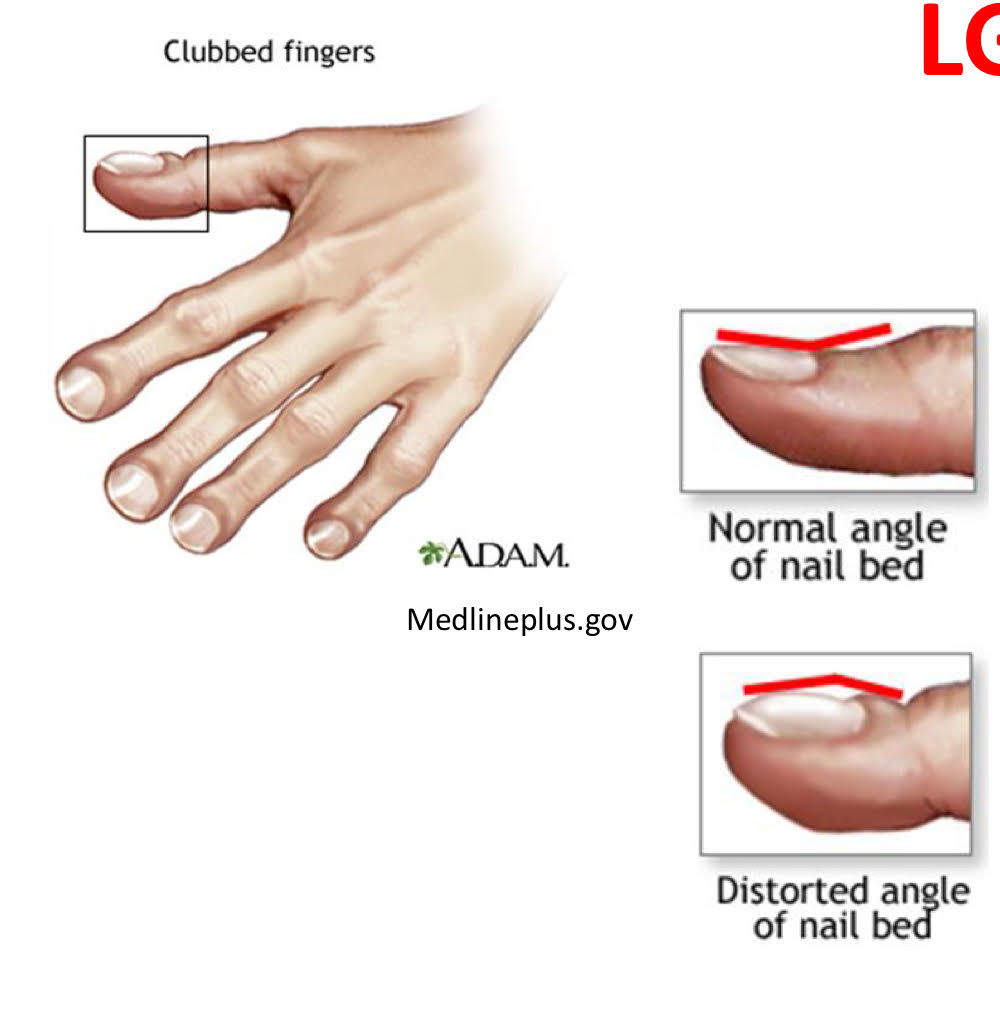<ul><li><p>adults burrow into mucosa + feed </p><ul><li><p>trauma to intestinal lining </p></li><li><p>this trauma is called “colitis”</p></li></ul></li></ul><ol><li><p>chronic hemorrhage + anemia: ~0.005 ml blood/worm/day lost in stools. </p></li><li><p>increased peristalsis in LI: rectal prolapse (to come out) </p></li><li><p>trichuris dysentery syndrome (TDS) </p><ul><li><p>children </p></li><li><p>ex. 200 worms in a child and the child would needs an increase does of Fe 4.25 mg/day. </p></li><li><p>systemic effects</p><ul><li><p>stunted growth </p></li><li><p>impaired cognitive function</p></li><li><p>finger + toe clubbing </p></li></ul></li></ul></li><li><p>children → heavy infections (children love to play in the dirt and trichuris trichiura live in the soil) </p></li></ol><p></p>