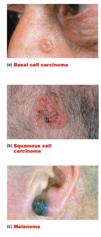 <p>3 types of Skin Cancer</p><ul><li><p><span style="color: red;">Basal cell carcinoma&nbsp;</span><br>- Stratum basal cells proliferate, invading the dermis and subcutaneous tissue<br>- Least Malignant and most common<br>- Full cure after removal</p></li></ul><p></p><ul><li><p><span style="color: red;">Squamous cell carcinoma</span><br>- Arises from keratinocytes of stratum spinosum<br>- Grows rapidly and metastasizes if not removed</p></li></ul><p></p><ul><li><p><span style="color: red;">Melanoma</span><br>- A cancer of melanocytes<br>-<strong> MOST DANGEROUS</strong> due to it being very invasive in nature</p></li></ul><p></p>