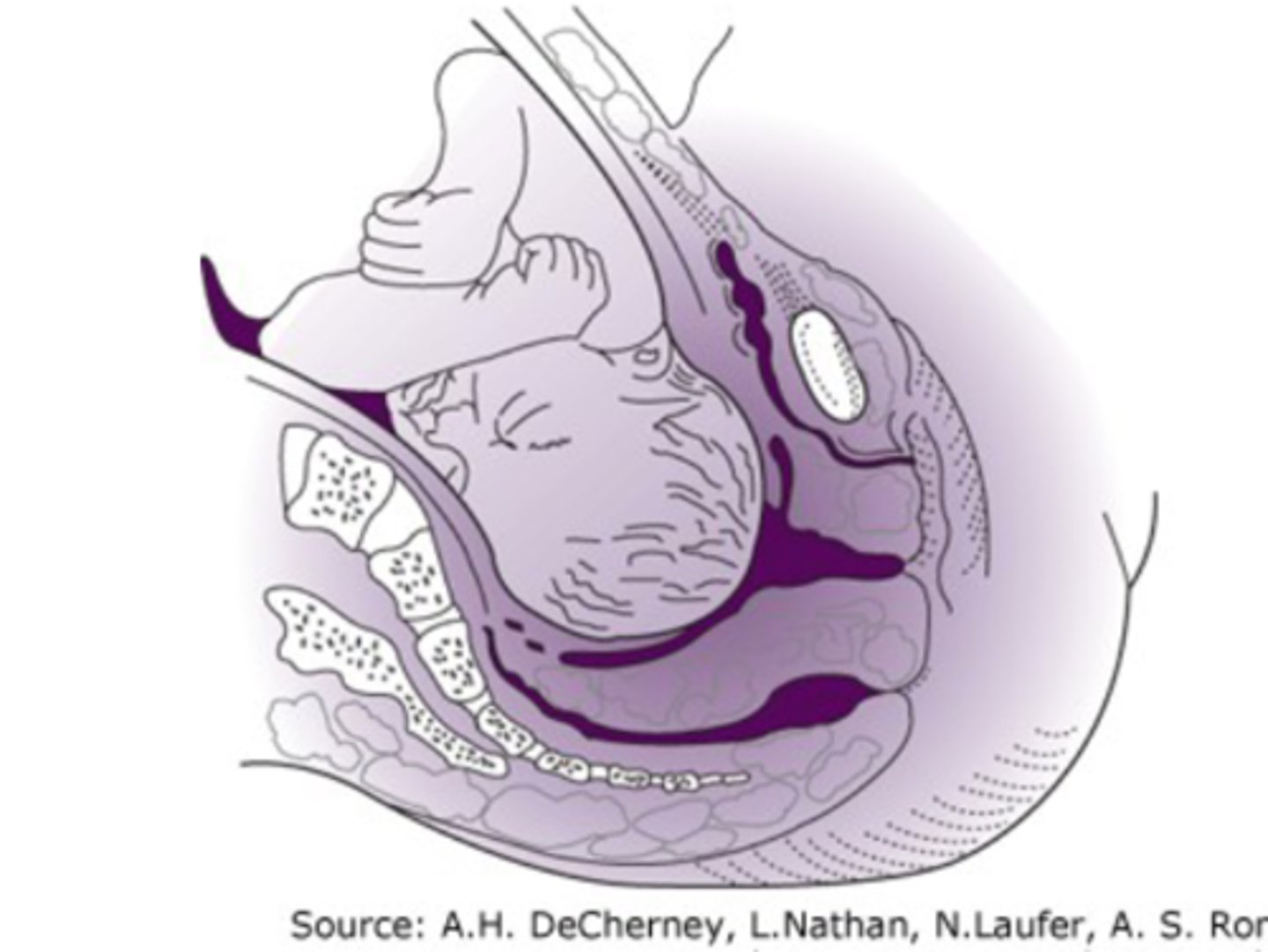 <p>-head is sitting in pelvic inlet</p><p>-happens in last 2 weeks</p>