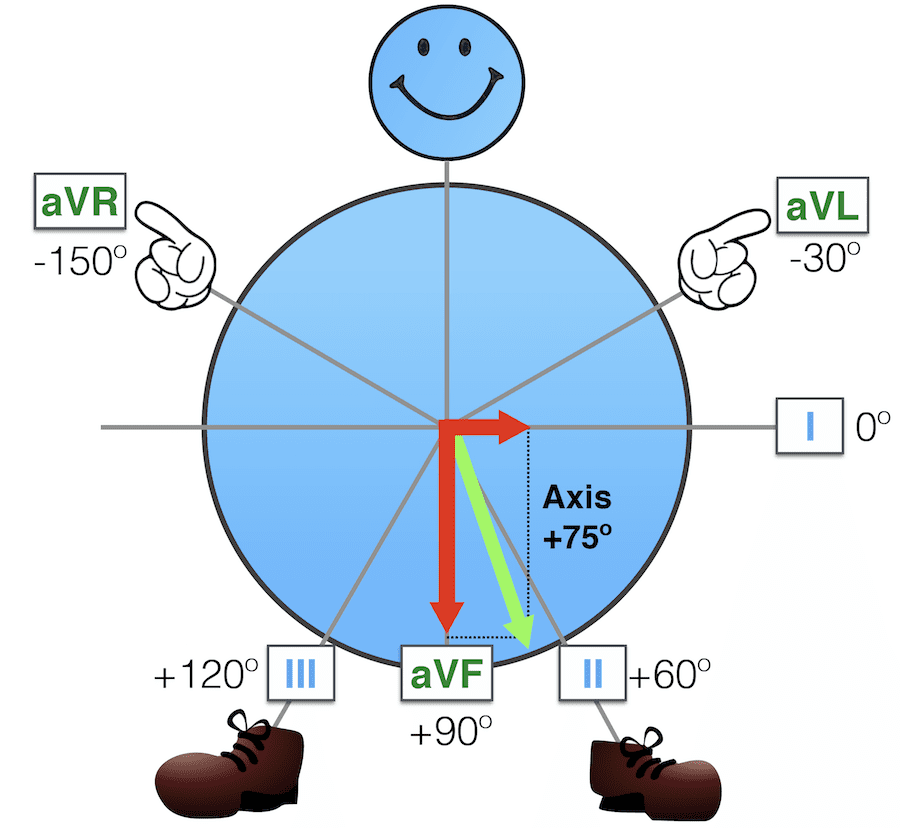 <ul><li><p>Leads 1 and aVF</p></li><li><p>In Lead 1 and AVF Measure the Net Deflection of the QRS Complex</p></li><li><p>E.G<br>- L1 = + 4<br>- aVF = +15</p></li><li><p>Draw it out and draw a line through the Corner. = The Axis Degree</p></li></ul><p></p>