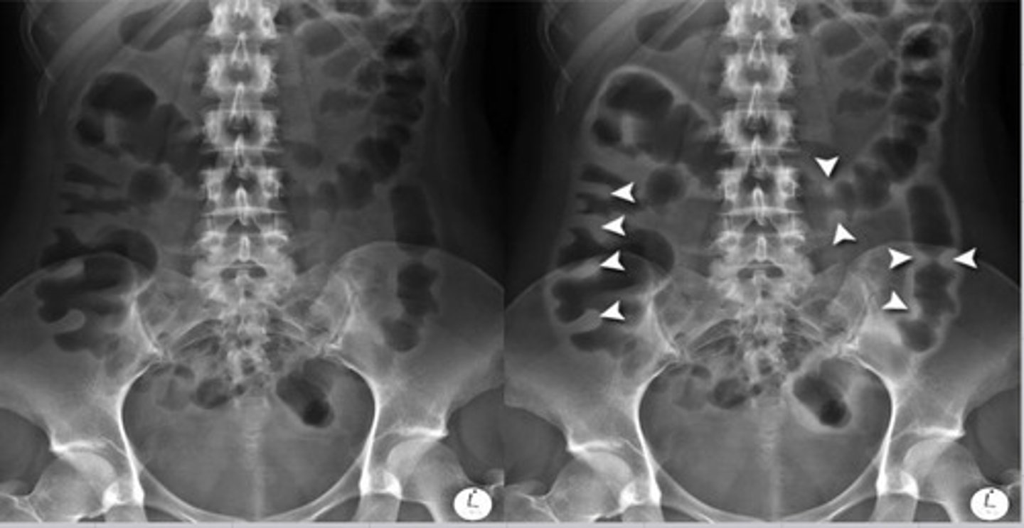<p>mucosal thickening of the haustra due to inflammation &amp; edema causing them to appear like thumb prints projecting into the lumen</p>