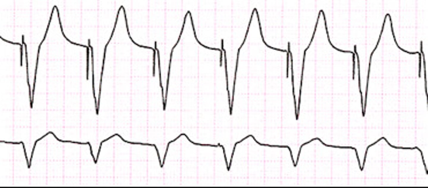 <p>pacemaker spike (may be small; sometimes missed)</p><p>- not supraventricular so wide QRS</p>