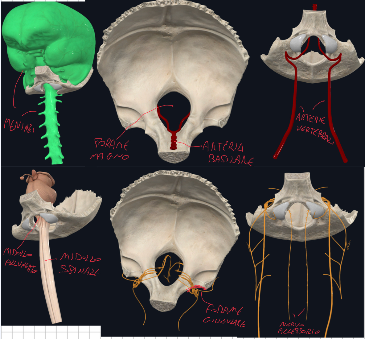 <p>Forame magno o grande foro occipitale:</p><ul><li><p>E’ la caratteristica principale di questo osso, si trova al centro della sua porzione basale</p></li><li><p>Collega la cavità cranica con il canale vertebrale, cioè è il punto di passaggio tra encefalo e midollo spinale</p></li></ul><p>Strutture che lo attraversano:</p><ul><li><p>Midollo Spinale, che risalendo prende nome di bulbo o midollo allungato, prima parte del tronco encefalico</p></li><li><p>Meningi spinali che si continuano con quelle encefaliche, però solo il foglietto meningeo è continuo tra dura madre spinale ed encefalica, quello periostale è si riflette sulle ossa del neurocranio</p></li><li><p>Nervo Accessorio (XI): le sue radici risalgono attraverso il foro ed escono dal Forame Giugulare insieme al Glossofaringeo e Vago</p></li><li><p>Arterie Vertebrali che si uniscono a formare l’arteria basilare (importante per la circolazione cerebrale posteriore)</p></li></ul><p></p>