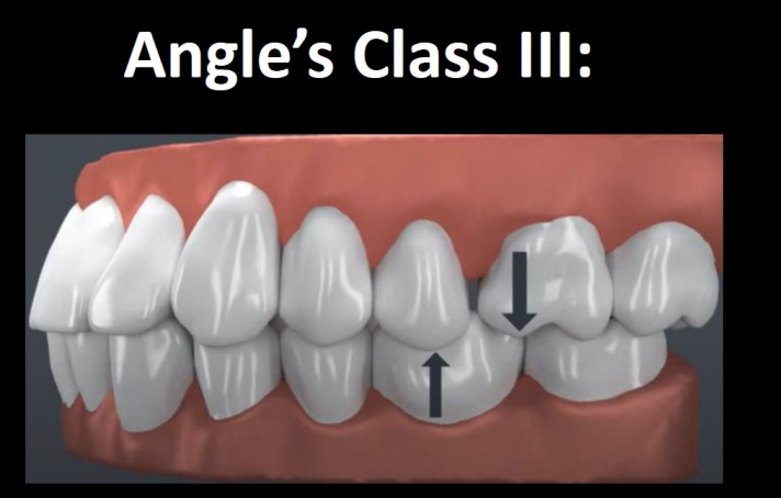 <p>The MB cusp of max 1st is over the embrasure btwn the mand 1st and 2nd molar </p>