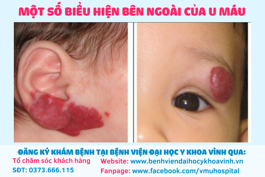 <p>u máu</p>