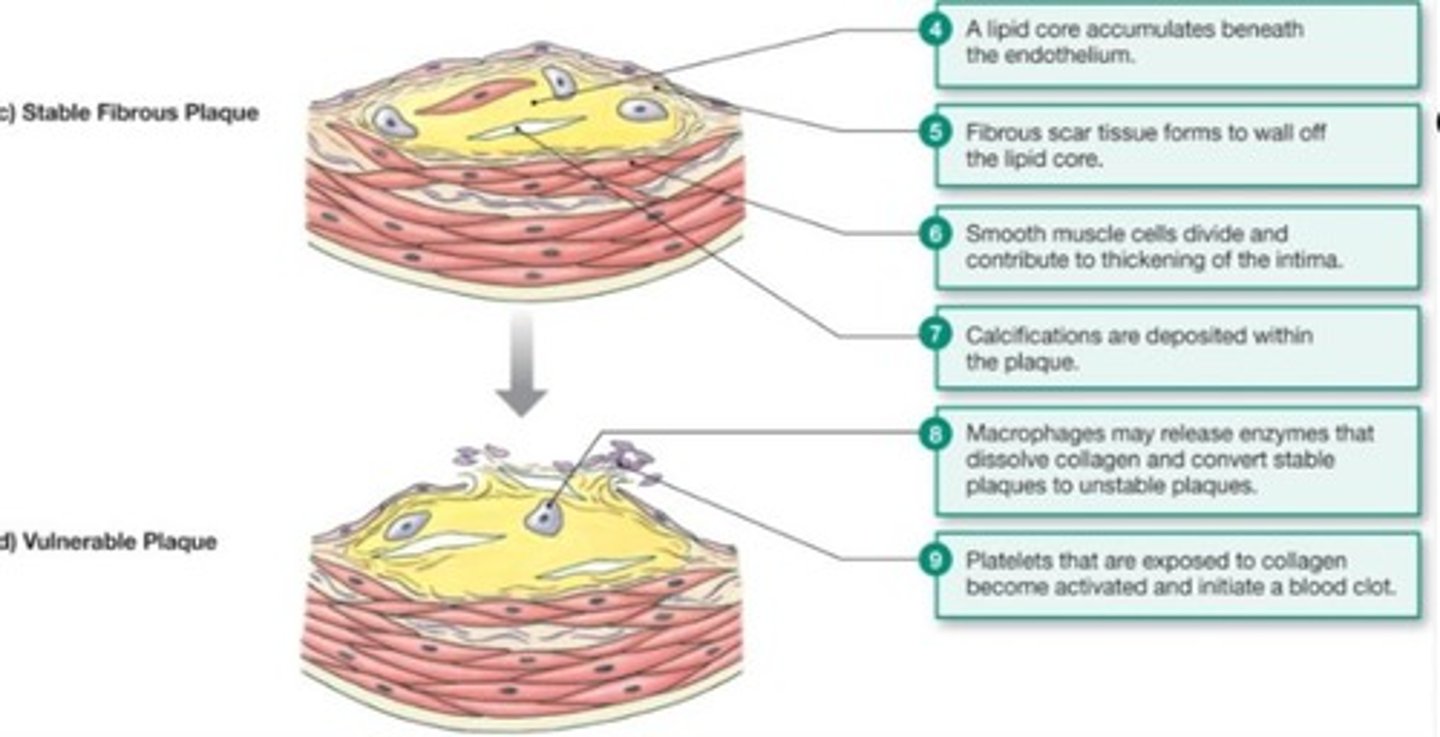 <p>Atherosclerosis is primarily caused by an inflammatory process associated with increased blood cholesterol and triglycerides.</p>