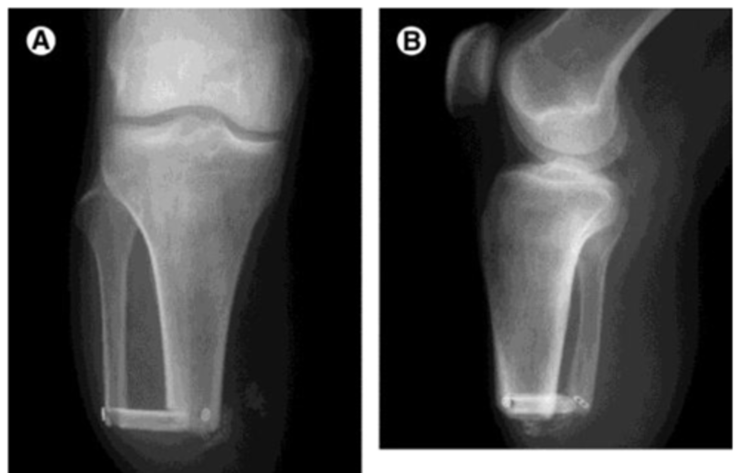 <p>ERTL procedure (Still need a prosthetic but helps create a little more structure)</p>