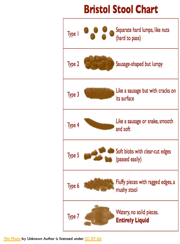 <p>Bowel movements are reduced to 3 or less per week.  Stools are dry, small and difficult to eliminate.</p><p>Can be caused by inadequate water intake, lack of physical activity or healthy diet, and lack of good nerve and muscle function in the bowel</p><p>Treatment: Increase hydration and fiber</p><p></p>
