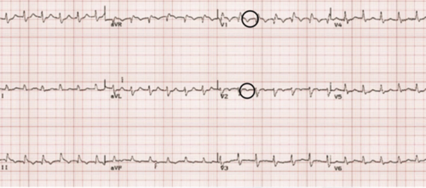 <p>right ventricular strain can cause T wave inversions in right chest leads</p>