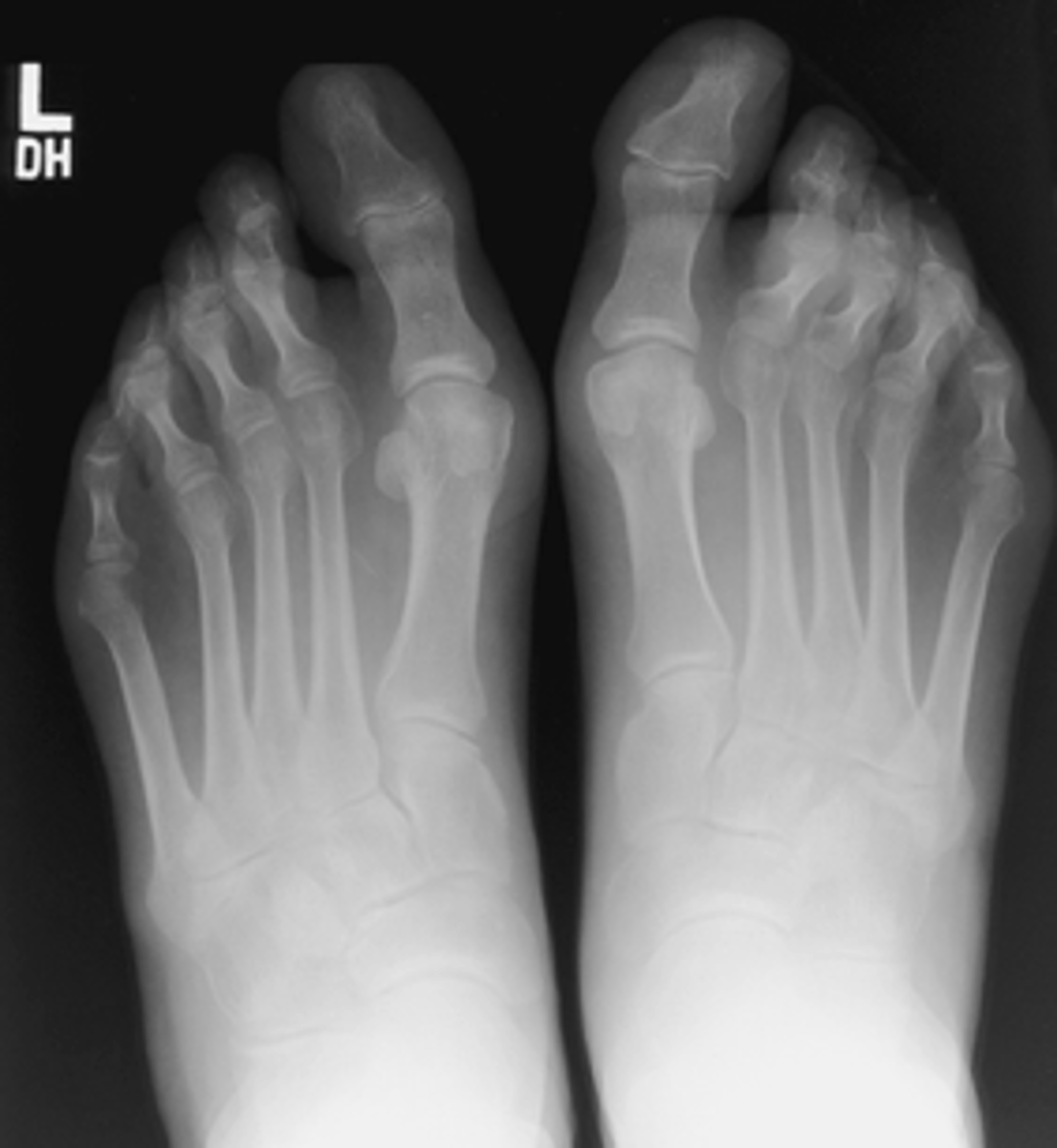 <p>- CR 15 posterior</p><p>- CR to base of MTs</p><p>- Bilateral feet demonstated</p><p>- Phalanges and MTs not rotated</p>