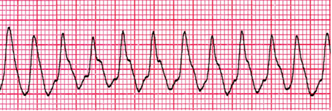 <p>Three or more PVCs in a row </p>