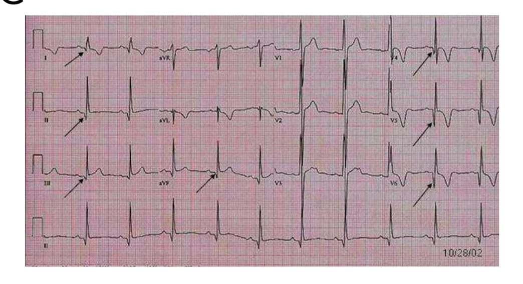 <p>giant t wave inversion is what cardiomyopathy</p>
