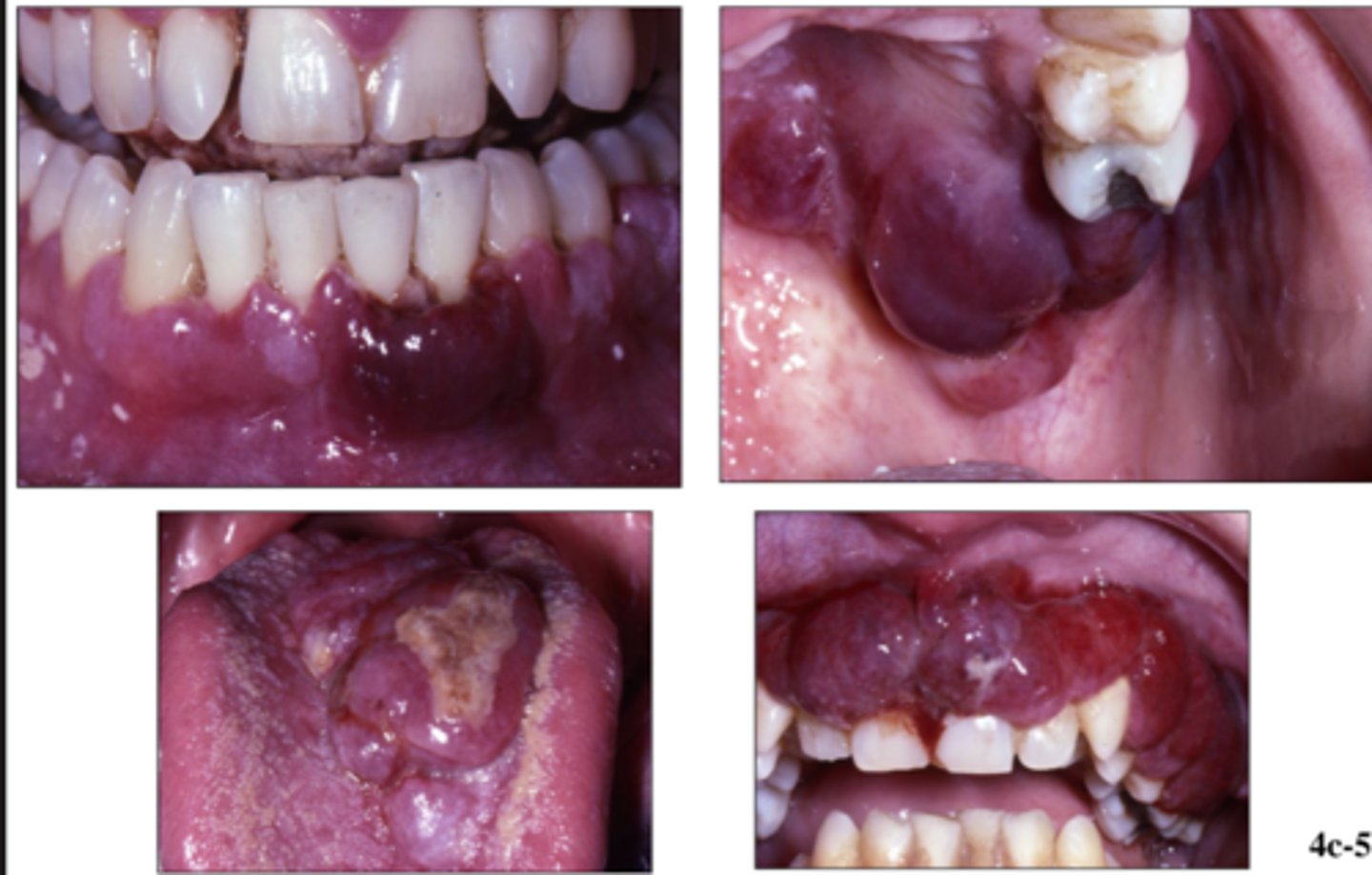 <p>HIV</p><p>clinically:</p><p>- reddish-purple</p><p>- on palate or gingiva</p><p>- multiple lesions</p><p>- 50% will present with intra oral lesions</p><p>prognosis is rarely fatal</p>