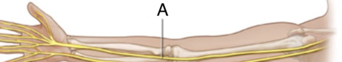 <p><span>Sensory-motor nerve that is smaller than the ulnar and radial nerves and that, with its branches, supplies the arm and hand.</span></p>
