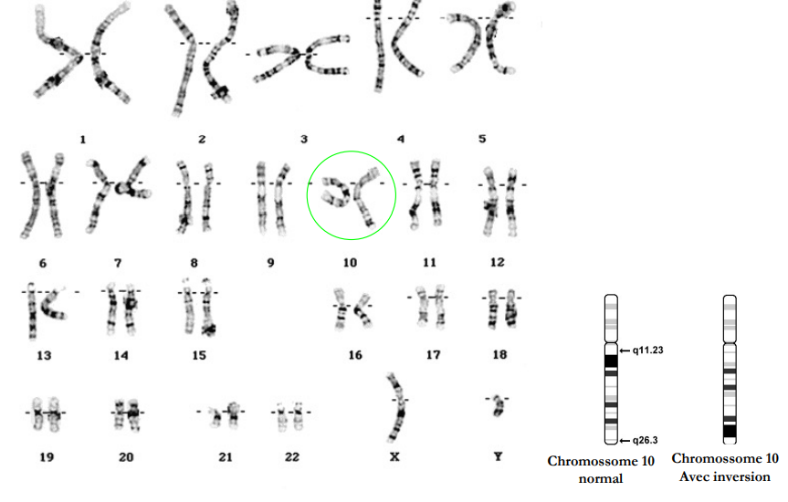 Quelle est l’anomalie associée à ce caryotype ? 