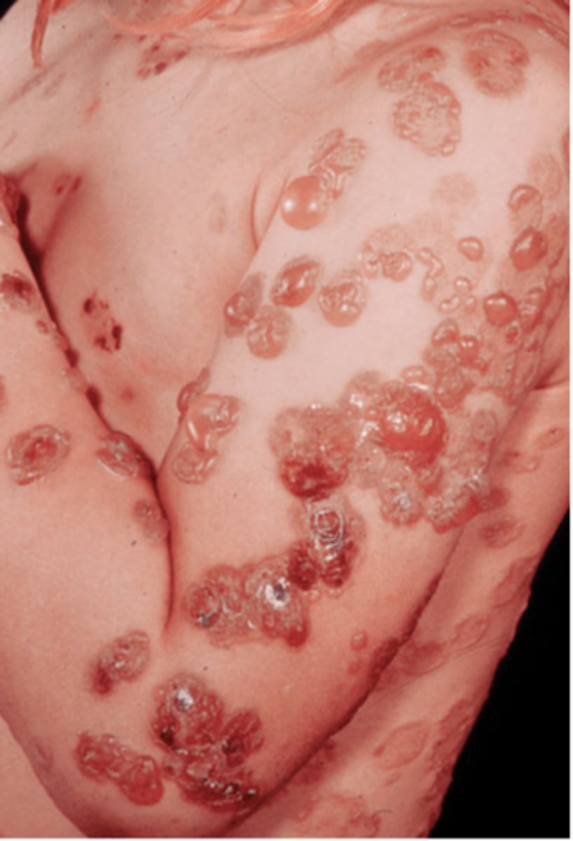 <p>-rare autoimmune blistering disease</p><p>-idiopathic or drug induced</p><p>-IgA antibodies bound to basement membrane zone</p><p>-humoral and cellular immune responses involved</p><p>-skin and/or mucosal membrane lesions: tense pemphigus-like vesicles and bullae</p><p>-tx: dapsone and topical corticosteroids</p>