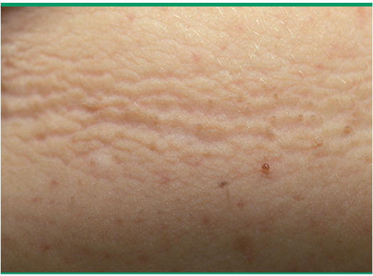 <p>common condition characterized by velvety, hyperpigmented plaques on skin; unknown cause</p>