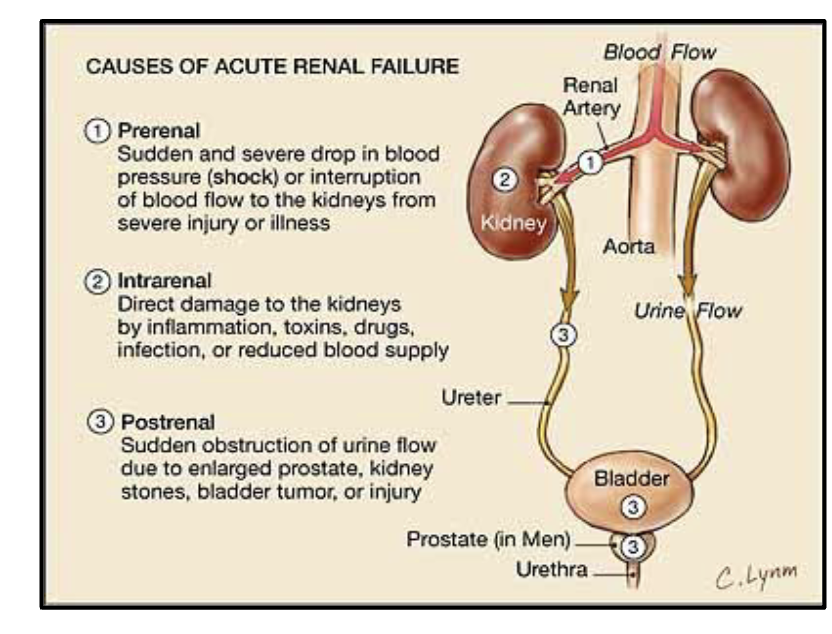 <ul><li><p>many causes:</p><ul><li><p>trauma, shock, hypotension: reduces renal BF</p></li><li><p>acute infections/sepsis</p></li><li><p>acute toxicity from drugs/poisons or foods containing toxins</p></li><li><p>massive urinary outflow obstruction</p></li></ul></li><li><p>problems when kidneys stop functioning</p><ul><li><p>water retention and generalized edema</p></li><li><p>uremia</p></li><li><p>electrolyte imbalance: potassium can’t be excreted, and levels increase in the blood (hyperkalemia) which can cause arrhythmias and asystole </p></li></ul></li></ul><p></p>