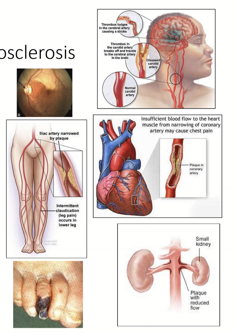 <ul><li><p>BRAO/CRAO: vision loss</p></li><li><p>Peripheral vascular disease: gangrene and amputations </p></li><li><p>CVA: Ischemic stroke</p></li><li><p>Heart: Ischemic heart disease → Dilated cardiomyopathy → CHF; Aortic Valve Disease → Hypertensive heart disease → CHF </p></li><li><p>Vascular: Arteriosclerosis</p></li><li><p>Abdominal aortic aneurysm</p></li><li><p>Renal stenosis</p></li><li><p>Death </p></li></ul><p></p>