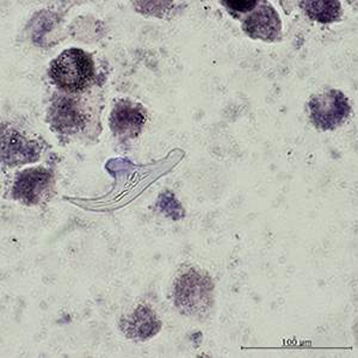 <p>-E. granulosus: cystic hydatid disease (sheep/dog intermediate host)</p><p>-E. multilocularis: alveolar hydatid disease (rat intermediate host)</p><p>-neither really seen in humans</p><p>-has protoscolex (immature scolex) meaning immature heads that are all like in one big sac!!!</p><p>-PASTORAL INFECTION: dog eat sheep</p><p>-SYLVATIC INFECTION: wolves vs coyotes</p><p>GRANULOSUS: cystic</p><p>-slowing enlarging cysts usually to the liver</p><p>-what we saw iin the video</p><p>MULTILOCULARIS: alveolar</p><p>-rapid growing, destructive </p><p>-usually in the liver but can go to lungs</p><p>EGG: protoscoleces with hooklets</p><p>-can see free hooklets/shark teeth</p><p>-PROTOSCOLICES!!!</p>