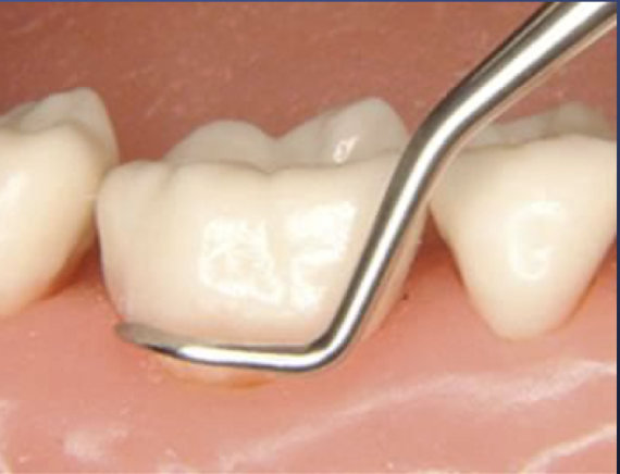 <p>is this the correct orientation of a posterior sickle scaler </p>