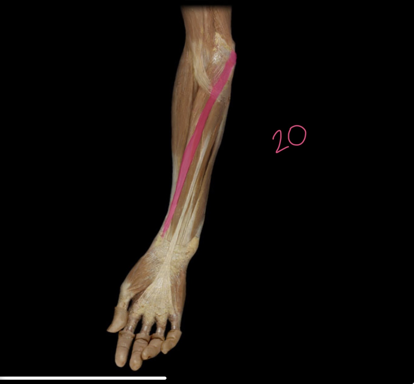 <p>Flexor carpi radialis</p>
