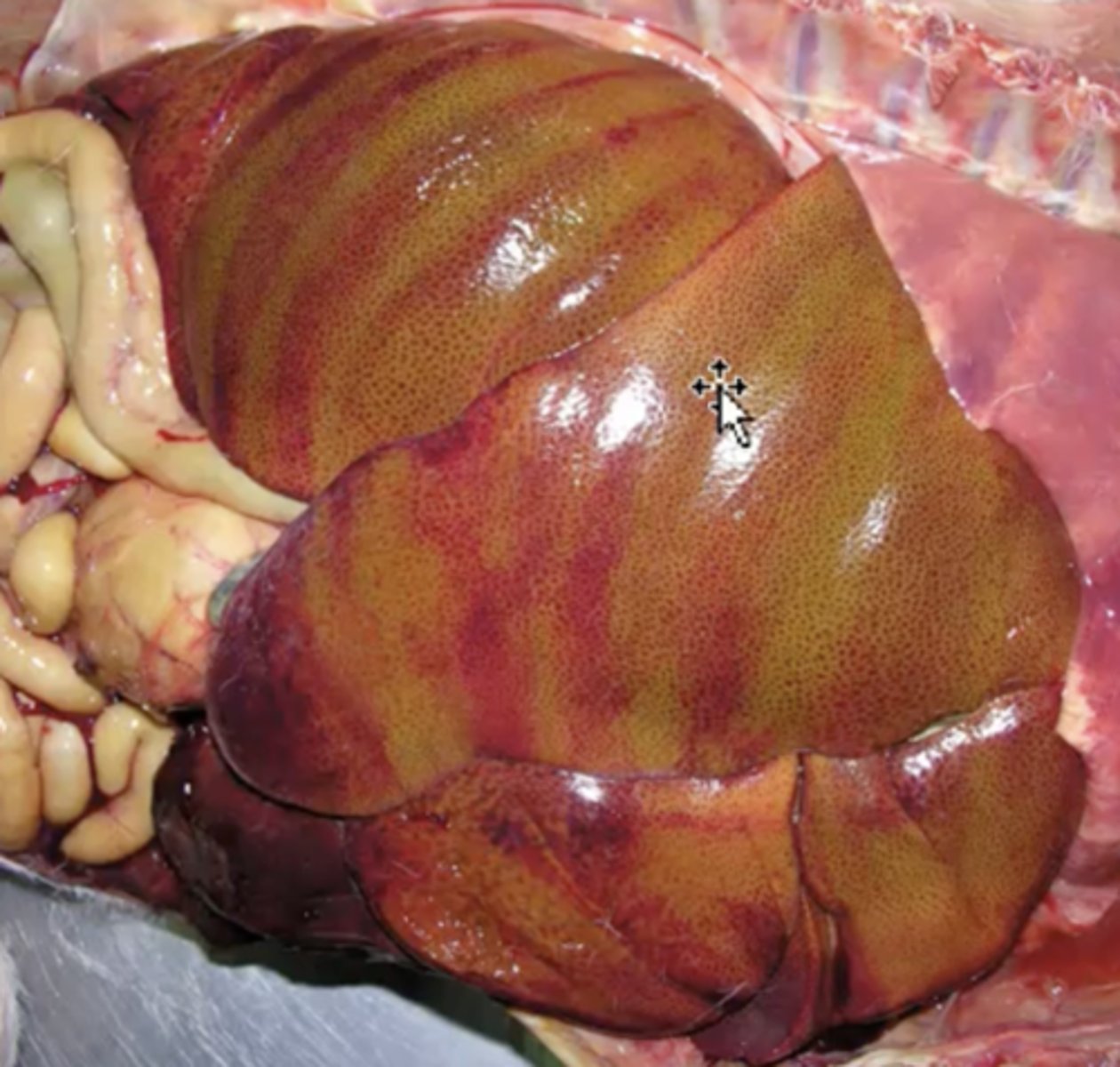<p>What has caused this gross appearance of this liver?</p>