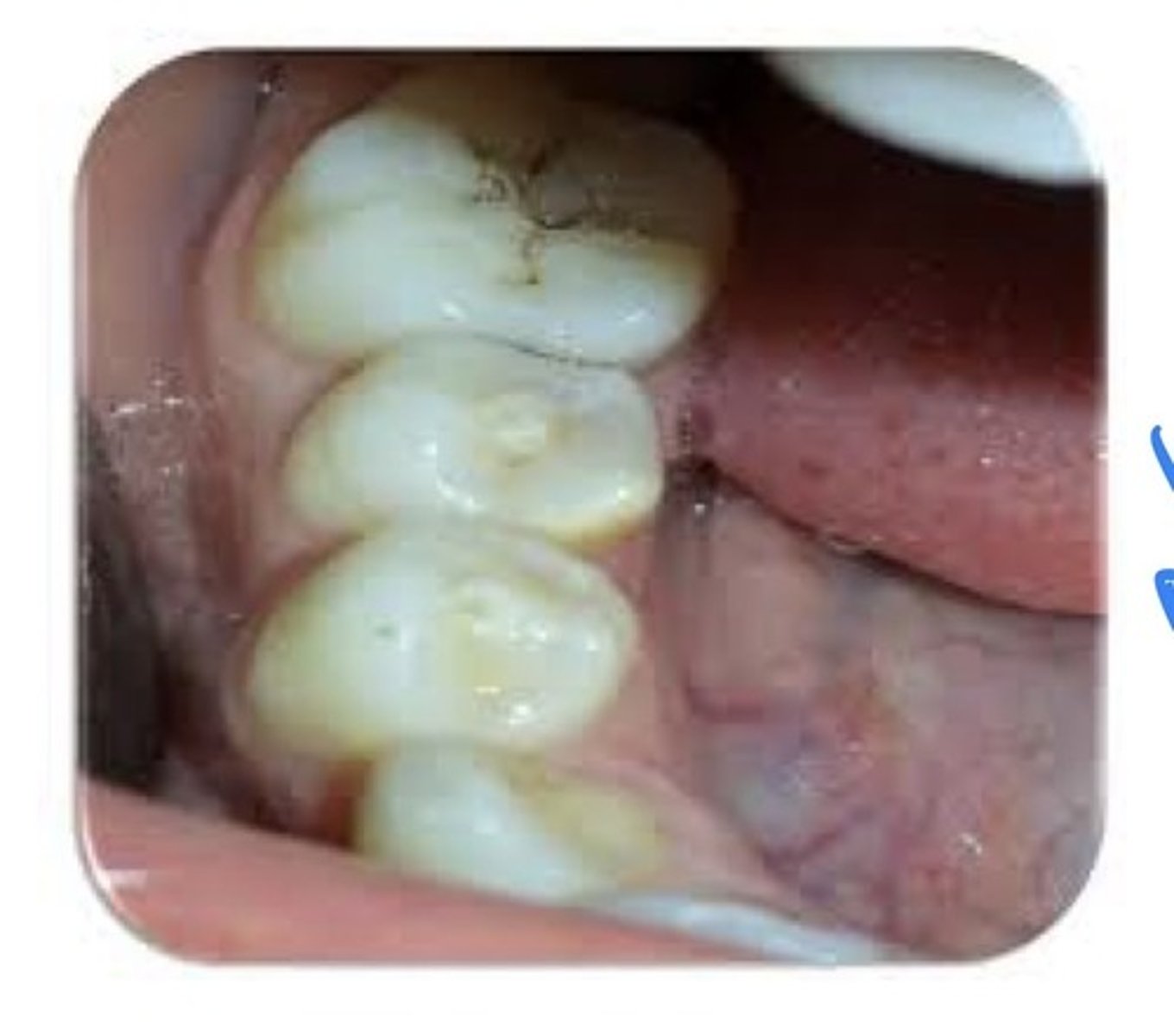 <p>An accessory enamel cusp found on the occlusal tooth surface. Most often seen on mand premolars. May cause occlusal problems.</p>