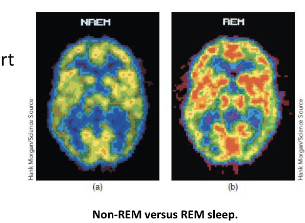 <p>A stage of sleep is associated with rapid and jagged brain wave patterns, increased heart rate, rapid and irregular breathing, rapid eye movements, and dreaming</p>