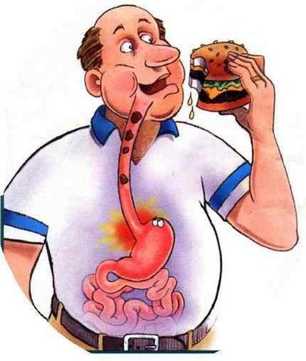 <p>Acid and pepsin reflux from the stomach into the esophagus, often due to lower resting tone of the lower esophageal sphincter.</p>