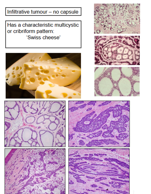 <p><span>Infiltrative Tumour with No Capsule</span></p><p><span>Characteristic Multicystic Cribriform Pattern </span>(swiss cheese)</p><p><span>A common feature of ACC is Perineural Invasion - shown on bottom right quadrant of bottom image</span></p><p><span>Not just cheese like structure but also other presentations shown on bottom image</span></p>