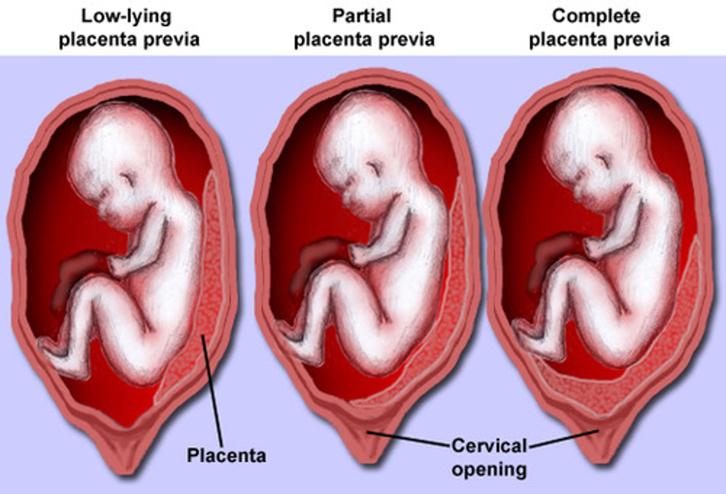 <p>ANYTHING AFTER 20 WKS = preterm</p><p>placenta implanted in lower uterine segment near or over internal cervical os</p><p>3 types: low-lying, marginal, complete placenta previa</p>