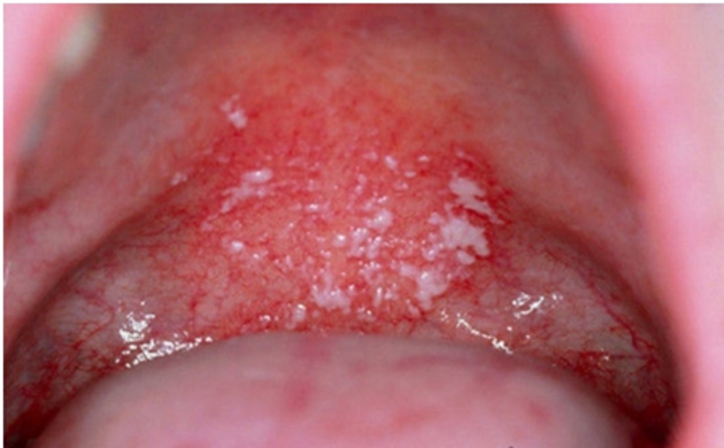 <p>White plaque that wipe off but leave red painful patches-classic presentation.</p><p>-Erythematous candidiasis-form of this that appears reddened-associated with HIV/AIDS clients.</p>