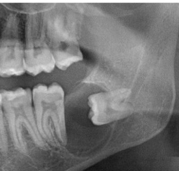 <p>describe the location of this lesion </p>