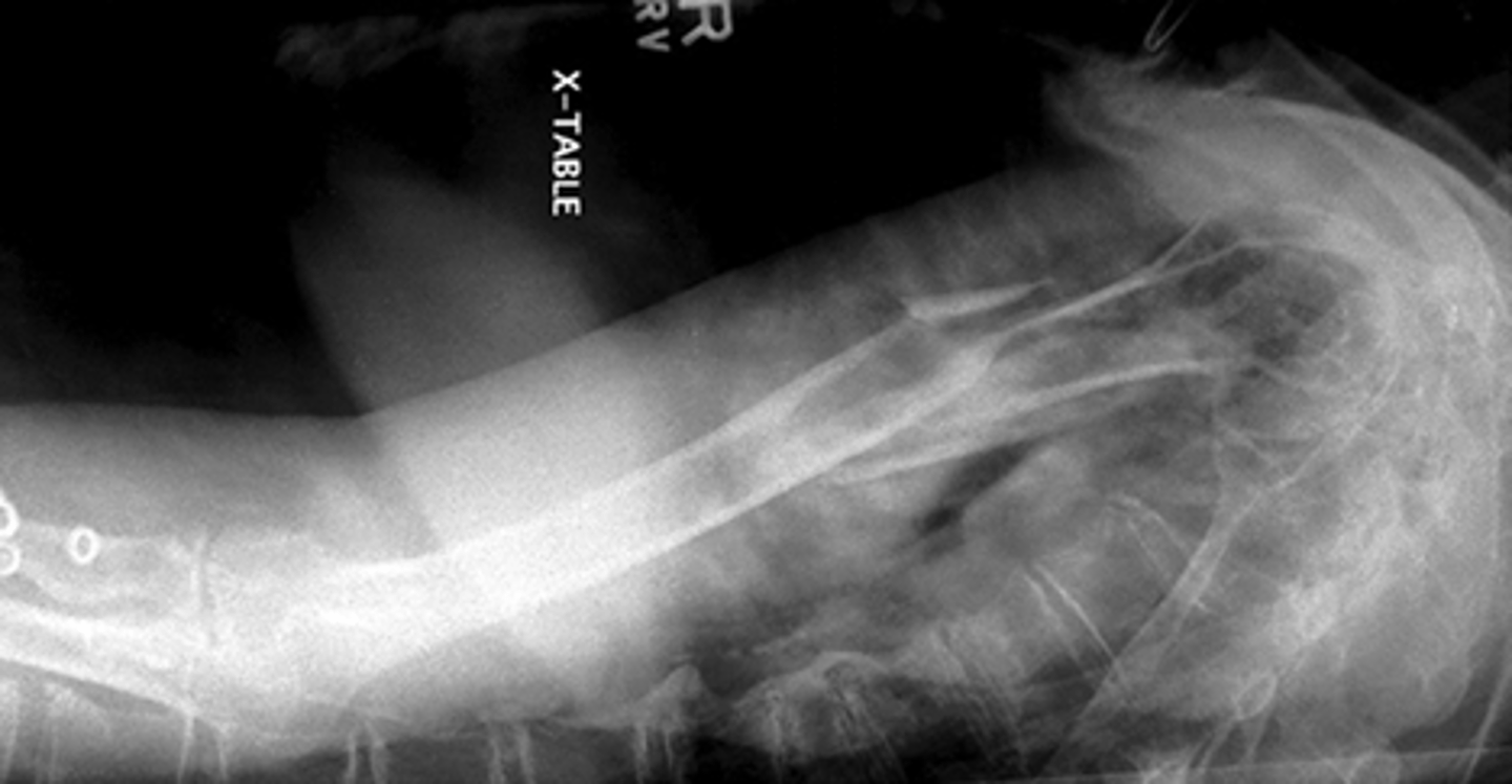 <p>- Demonstrates entire humerus without rotation</p><p>- Unaffected limb raised over head</p><p>- CR to mid aspect to involved humerus</p>
