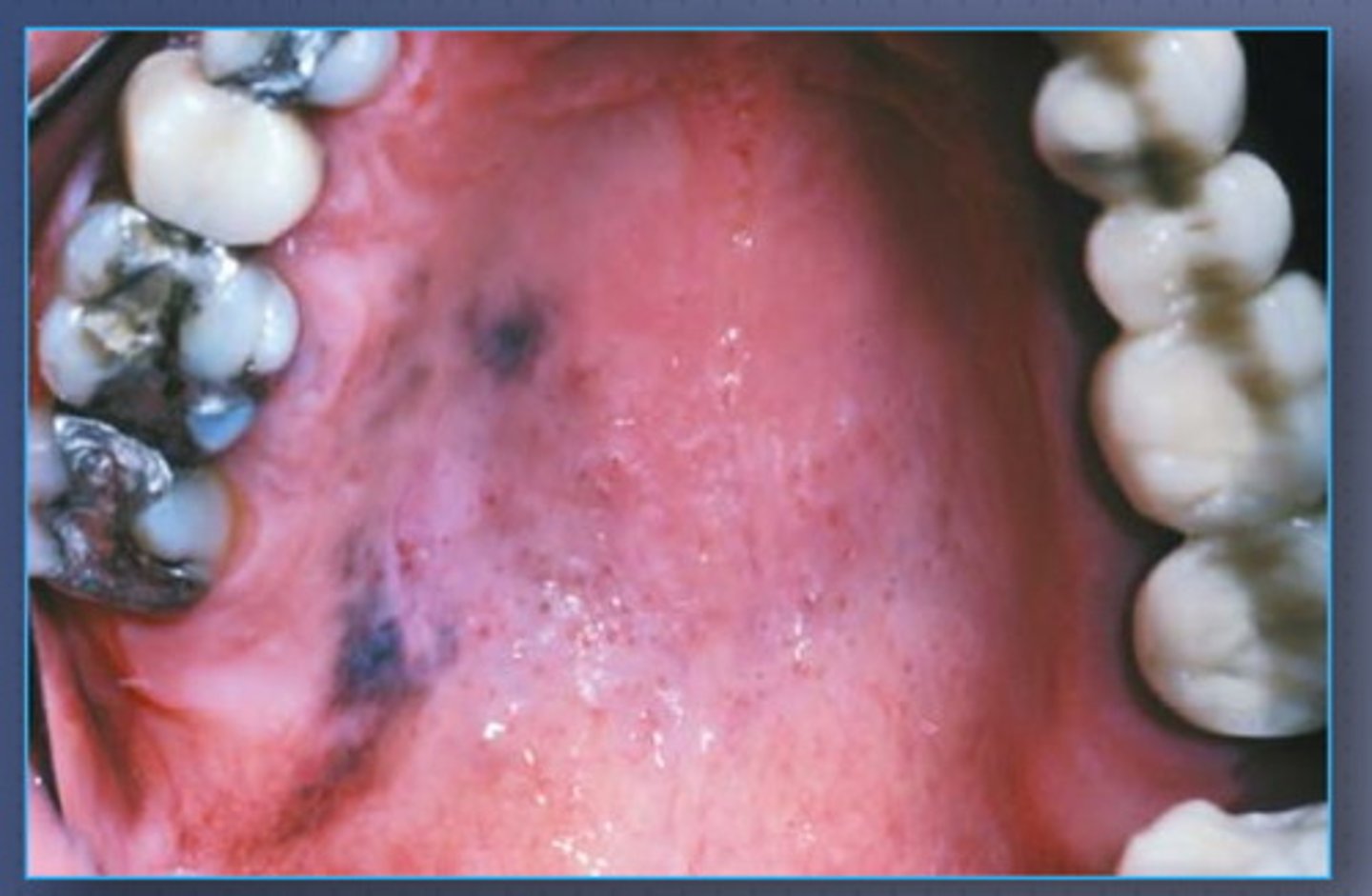 <p>blackish-blue, irregular papule </p><p>• poor prognosis</p><p>• common locations: palate, maxillary gingiva</p>
