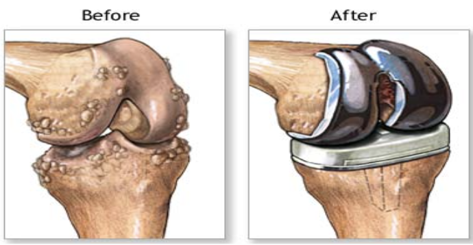 <p>knee prosthesis</p>