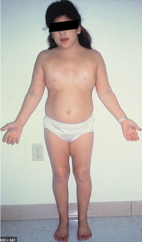 <p>The following clinical features are associated with what condition?</p><ul><li><p>short stature</p></li><li><p>webbed neck</p></li><li><p>wide spaced nipples</p></li><li><p>premature ovarian failure</p></li><li><p>CoA</p></li><li><p>normal intelligence</p></li></ul><p></p>