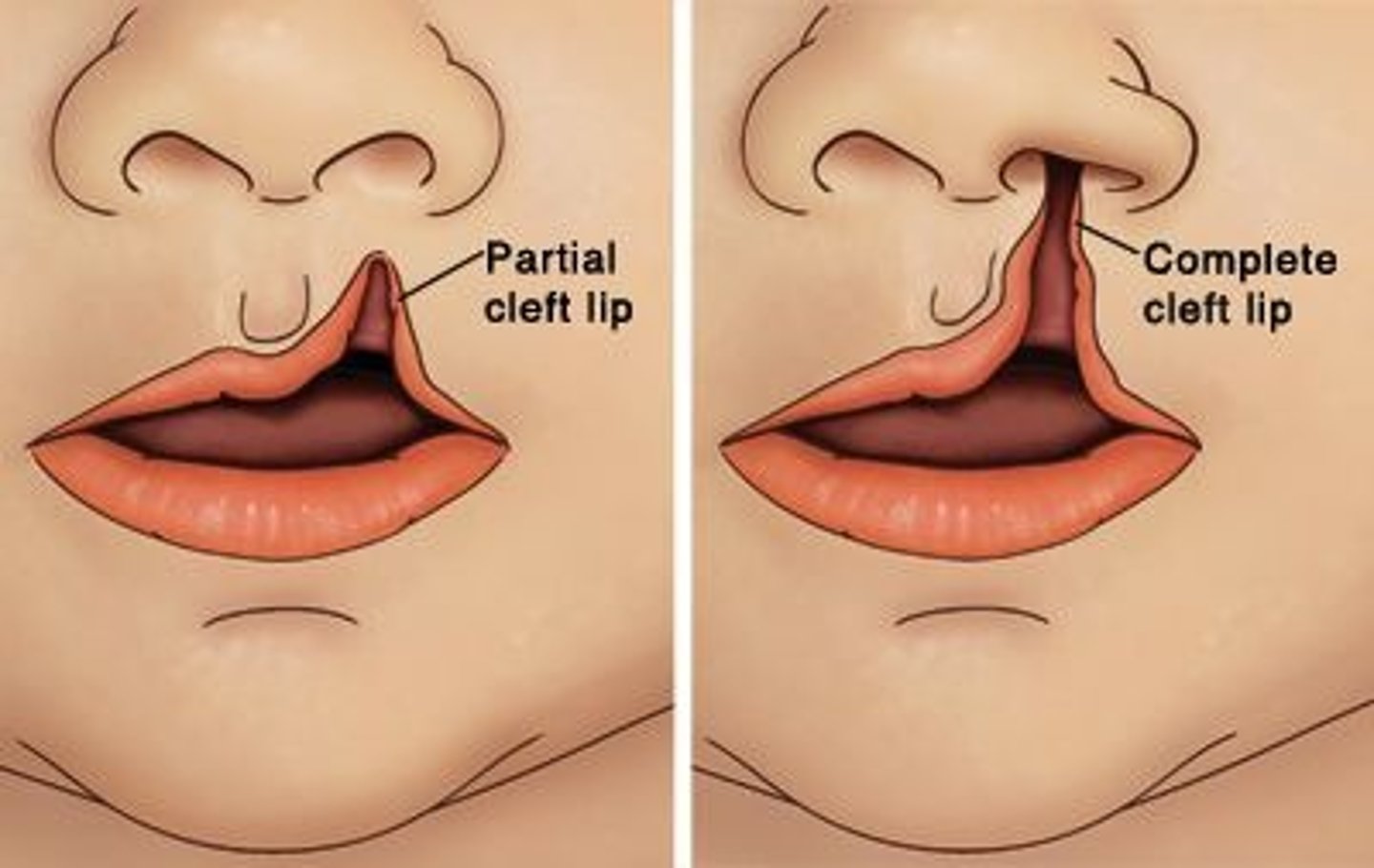 <p>What does complete cleft lip (CCL) extend from? </p>
