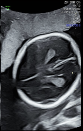 <p>which normal cranial structures are identified with<strong>in the lateral ventricles</strong> bilaterally</p><p>a) lobes of thalamus</p><p>b) choroid plexus</p><p>c) cerebellar pedicles</p><p>d) cavum septum pellucidum</p>