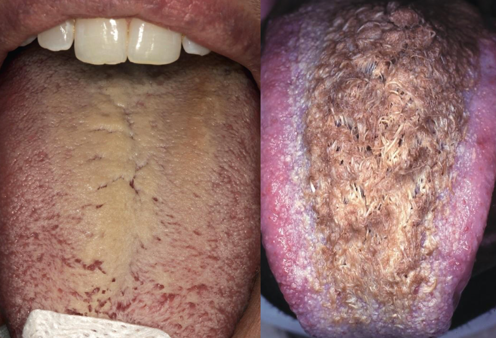 <p>which environmental/reactive lesion:</p><ul><li><p>“Hairy tongue”</p></li><li><p>Elongated filiform papillae on the dorsal surface of the tongue</p></li><li><p>Yellowish white, can be discolored</p></li><li><p>Heavy smokers, poor PO intake, dehydration, poor oral hygiene</p></li><li><p>Benign, esthetic concerns</p></li></ul><p></p>